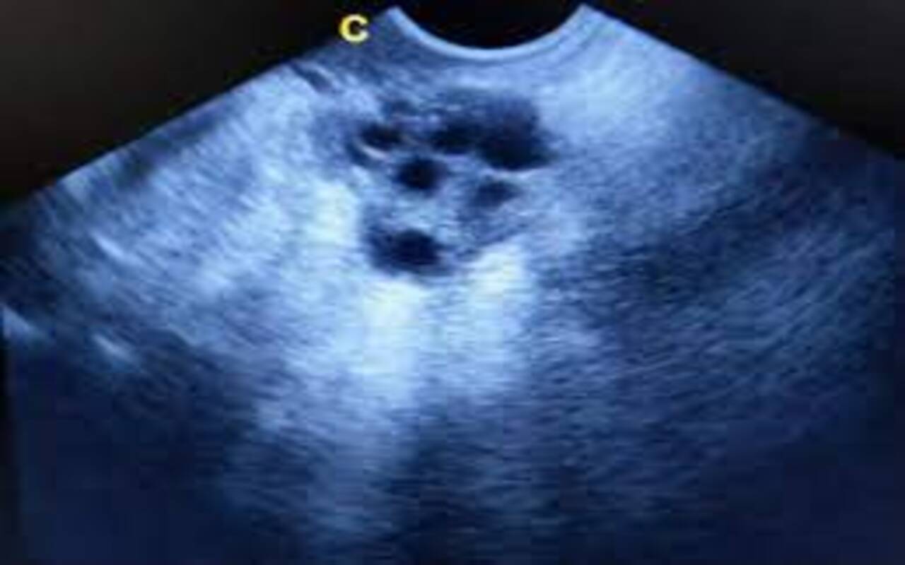 Photo of Ovaio Multifollicolare: cos’è, come si riconosce, gravidanza